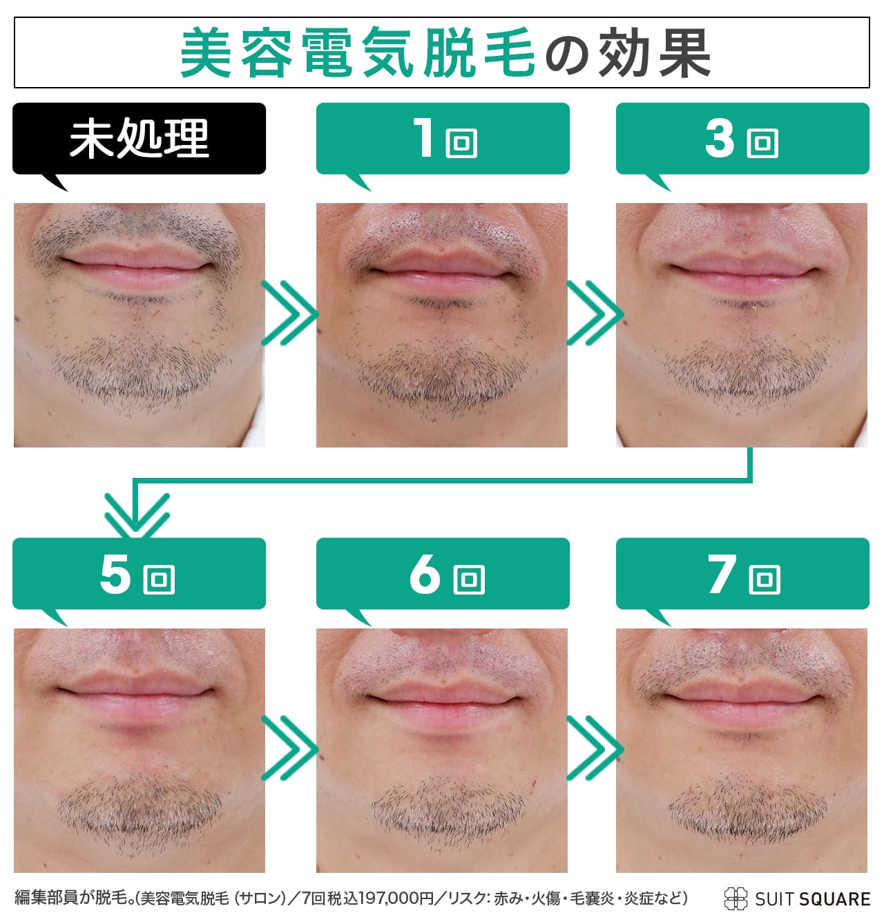 編集部ヒゲの美容電気脱毛0回から7回効果ビフォーアフター