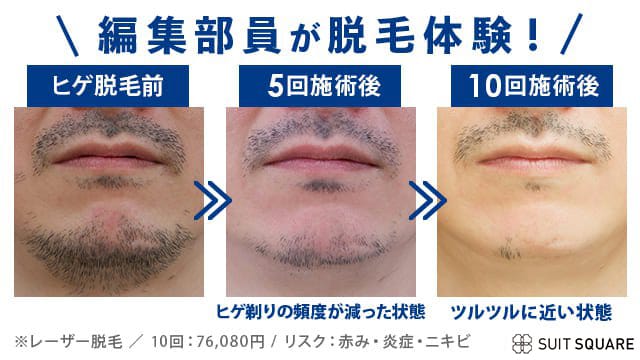 レーザー脱毛の回数と効果の目安