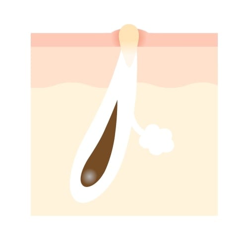 詰まり毛穴