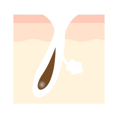 開いた毛穴