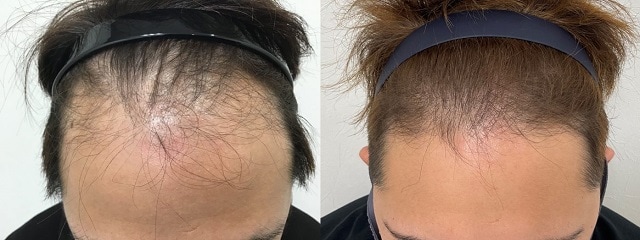 駅前AGAクリニックのAGA治療効果