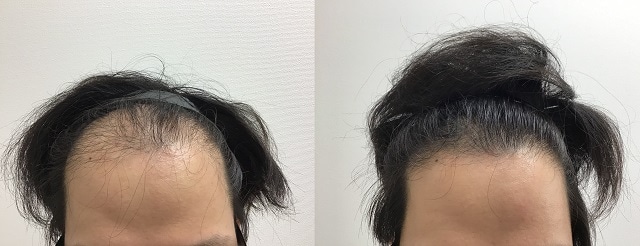 AGAオンラインクリニックのAGA治療効果