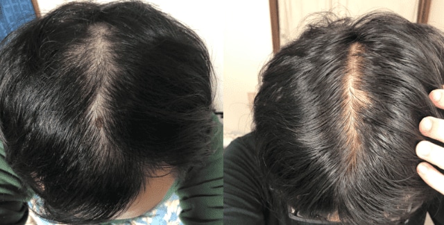 Hair's オンライン・ヘアウェルネスサービスのAGA治療効果