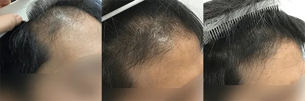 AGAヘアクリニックのAGA治療効果