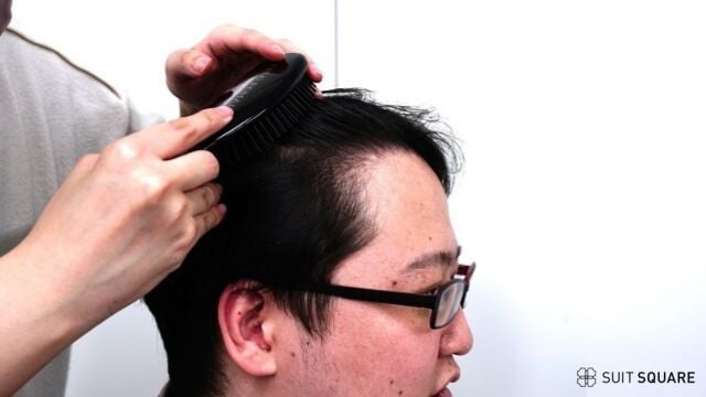 AGA診断を受けるTSDメンズ編集部員