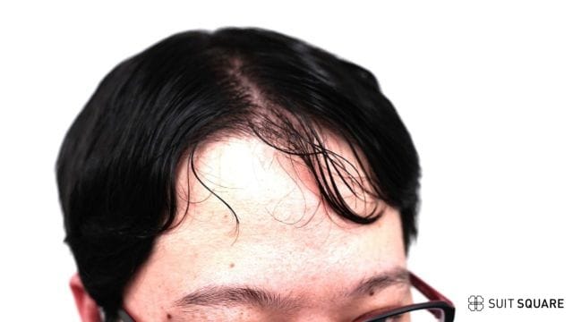 AGAを発症した男性の額