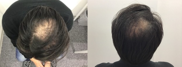 AGA治療前の男性の頭部