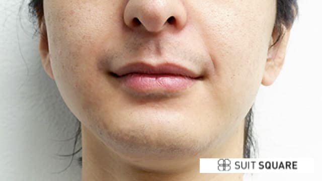 脱毛後のヒゲ