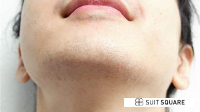 脱毛後のヒゲ