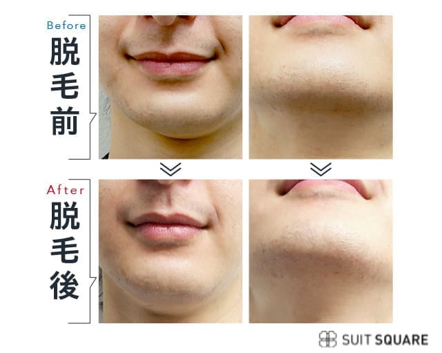 脱毛前後のヒゲを比較
