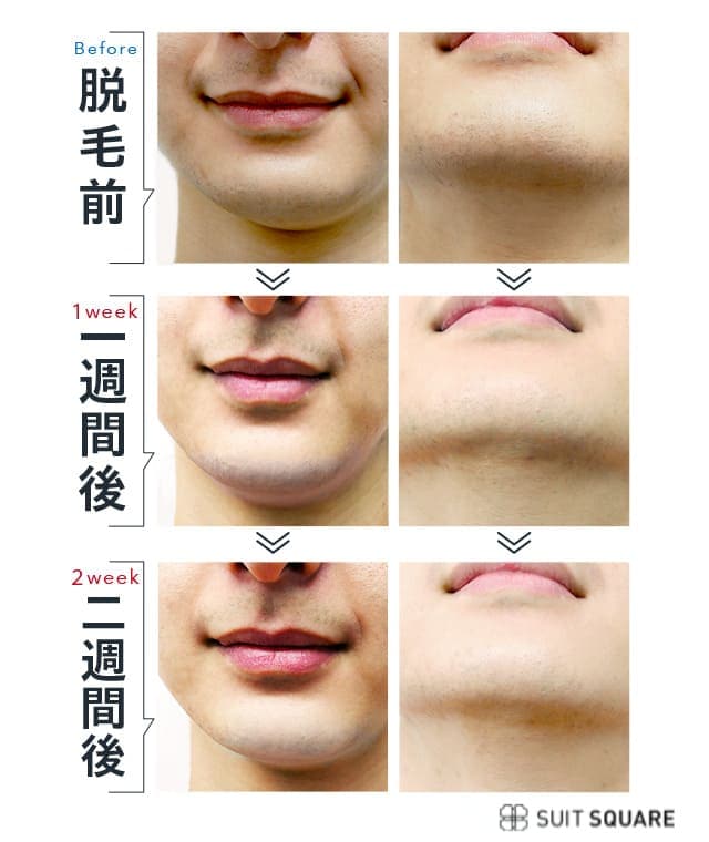 脱毛1週間後・2週間後のヒゲを比較