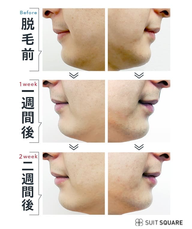 脱毛1週間後・2週間後のヒゲを比較