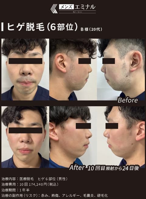 エミナルクリニックメンズ（メンズエミナル）のヒゲ脱毛の効果