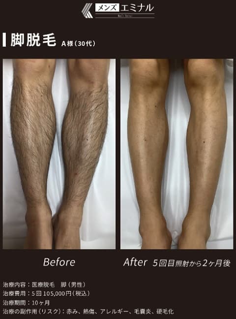 エミナルクリニックメンズ（メンズエミナル）の脚脱毛の効果