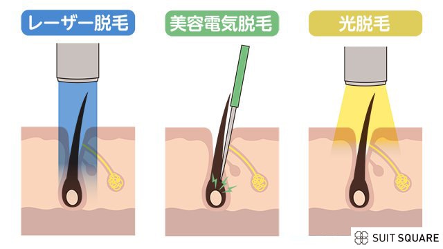 レーザー・美容電気針・光の脱毛方法の種類の違い