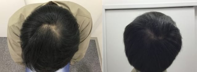 AGA治療1年後の男性の頭部