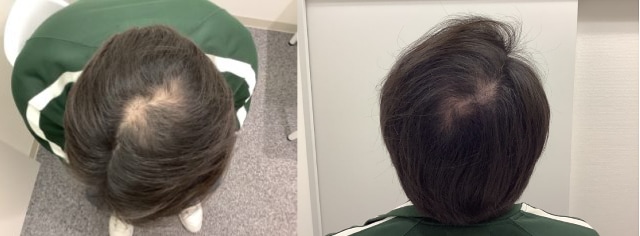 AGA治療3か月後の男性の頭部